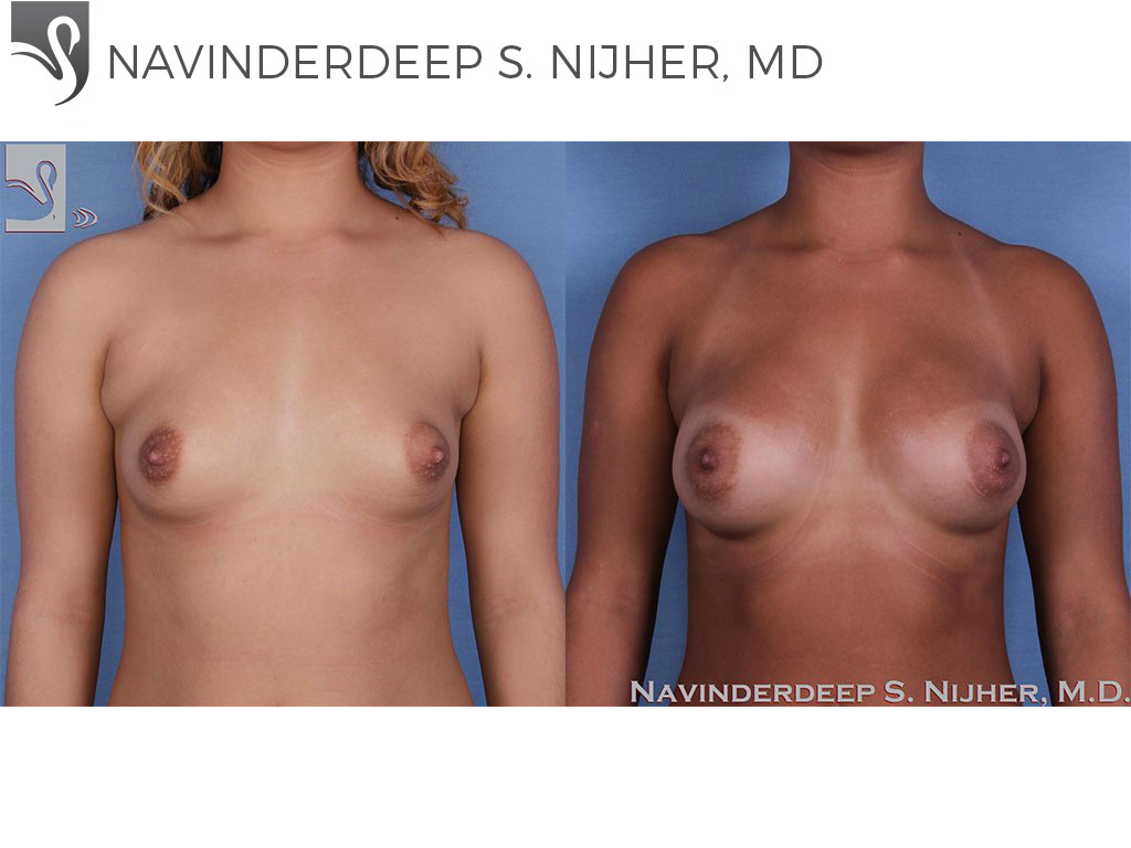 Before and After Image: Breast Augmentation Case #57138 - front