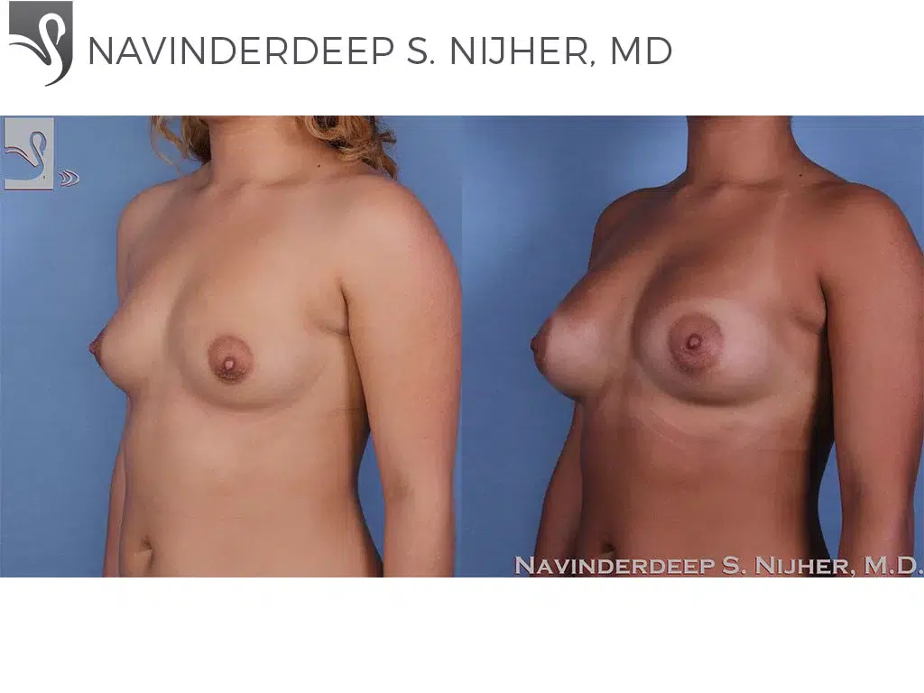 Before and After Image: Breast Augmentation Case #57138 - left-front-oblique
