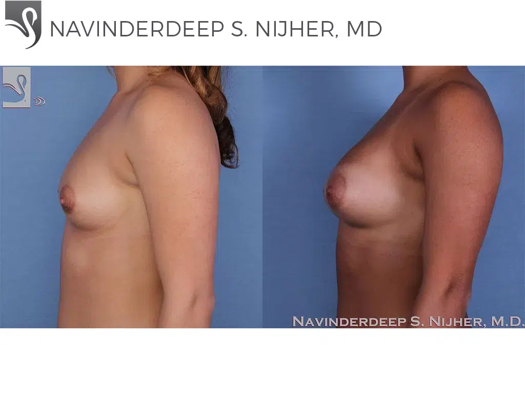 Before and After Image: Breast Augmentation Case #57138 - left-side