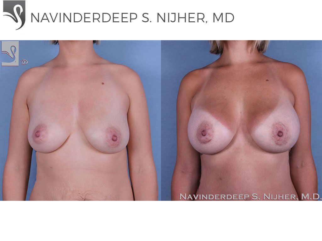 Before and After Image: Breast Augmentation Case #57354 - front