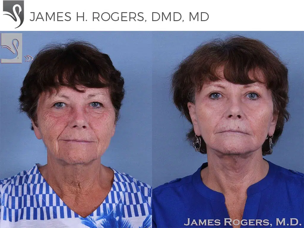 Before and After Image: Face Lift Case #57509 - front