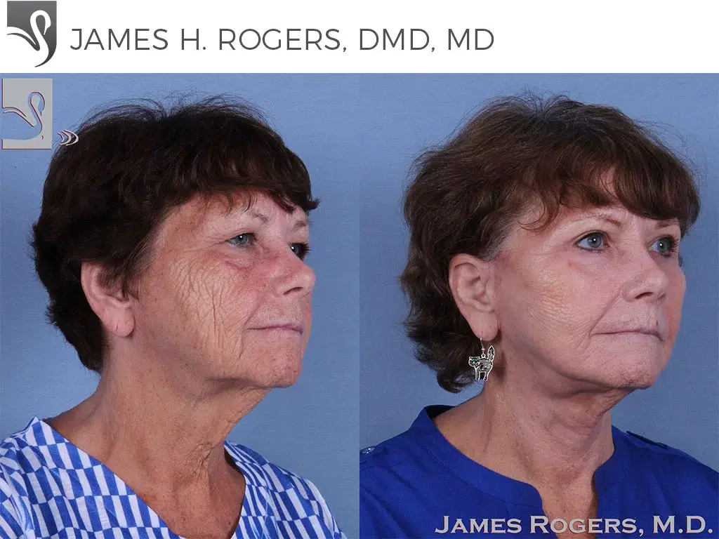 Before and After Image: Face Lift Case #57509 - right-front-oblique