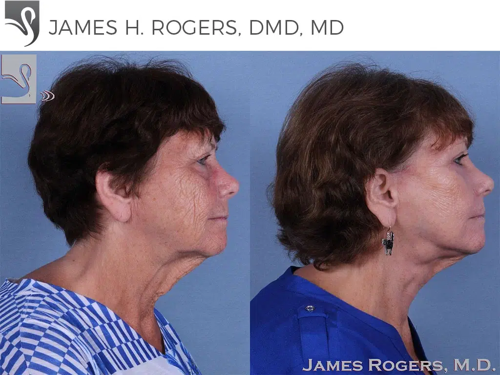 Before and After Image: Face Lift Case #57509 - right-side