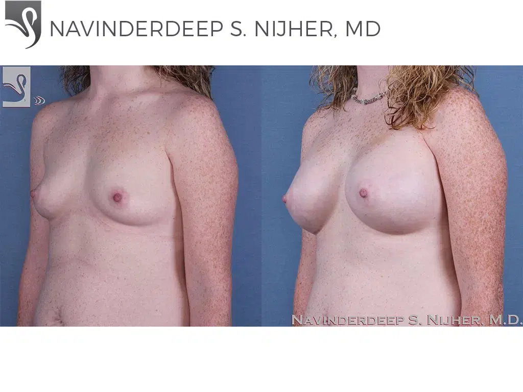Before and After Image: Breast Augmentation Case #57646 - left-front-oblique
