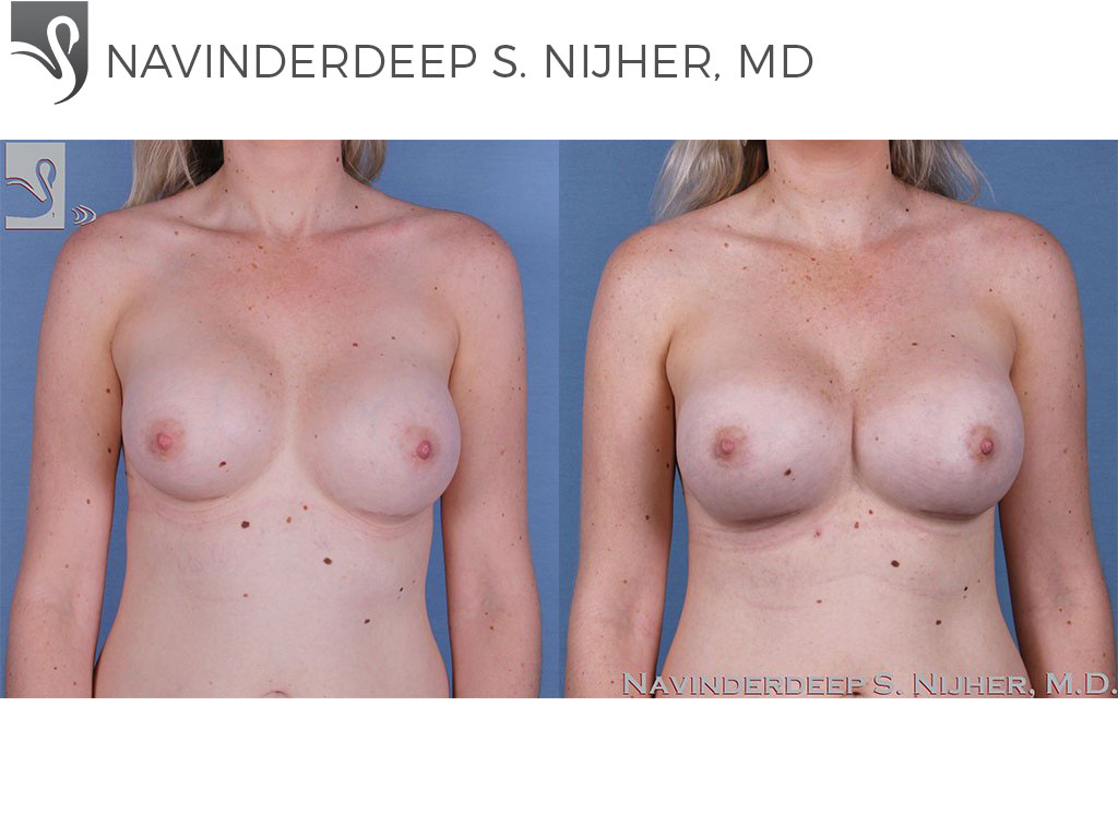 Before and After Image: Breast Revisions Case #58214 - front