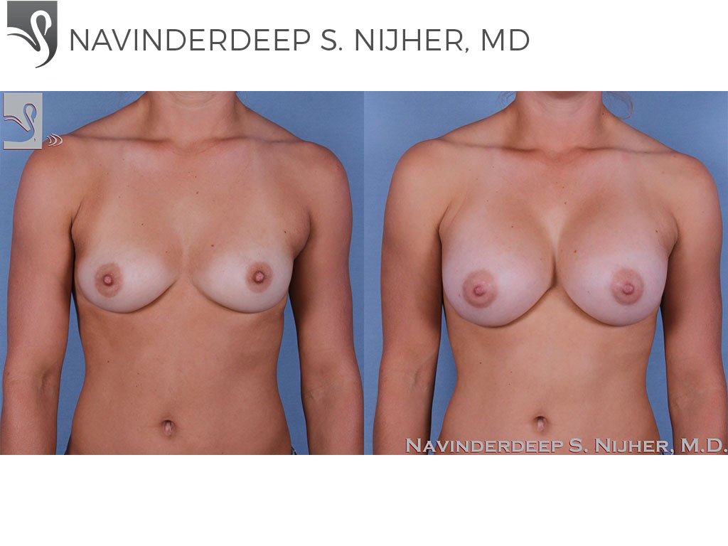 Before and After Image: Breast Augmentation Case #58290 - front