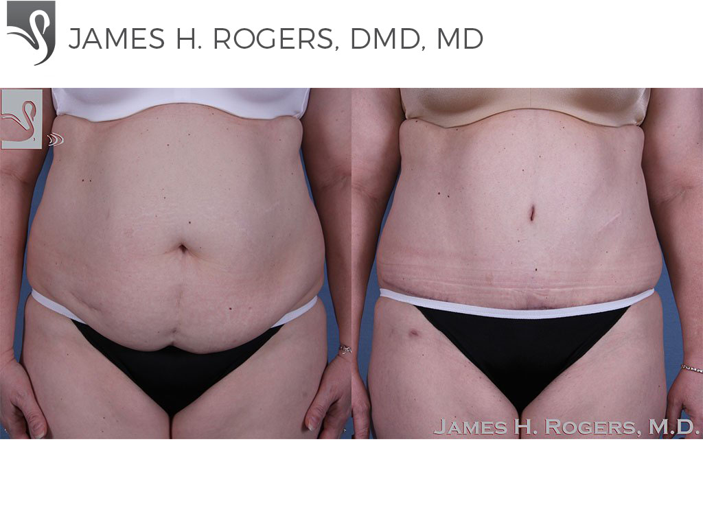 Before and After Image: Abdominoplasty (Tummy Tuck) Case #58407 - front
