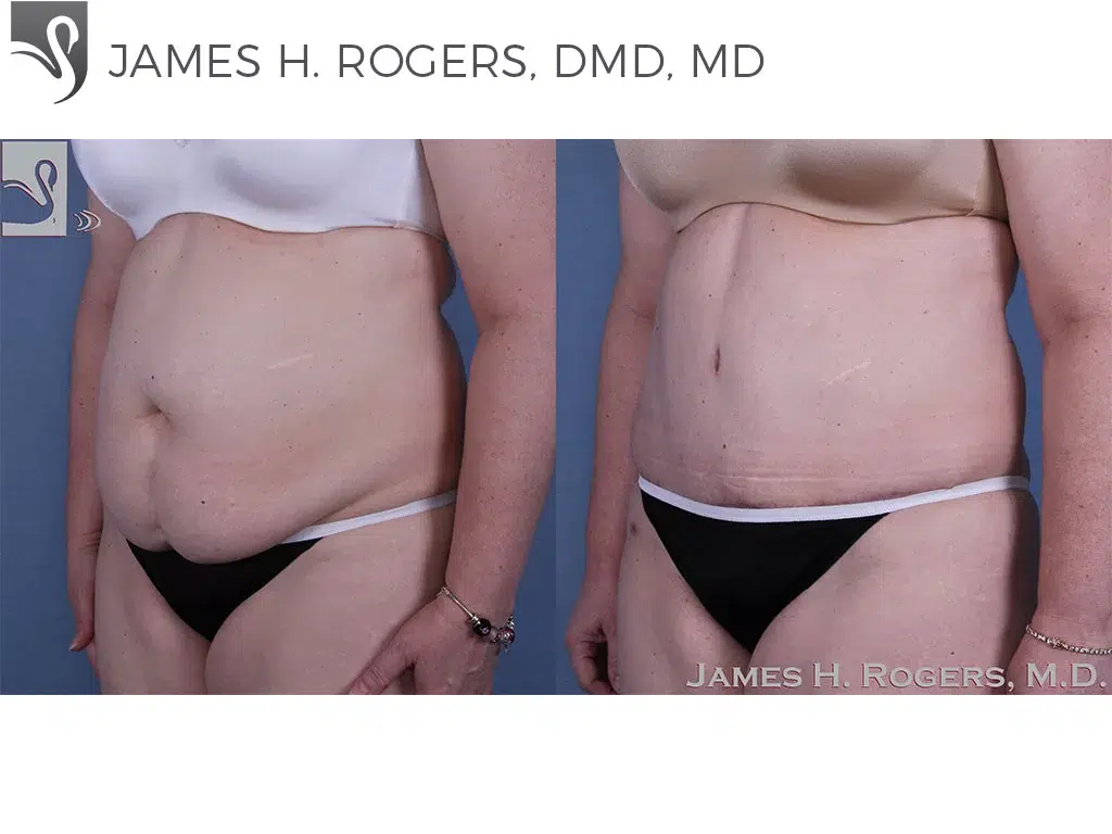 Before and After Image: Abdominoplasty (Tummy Tuck) Case #58407 - left-front-oblique