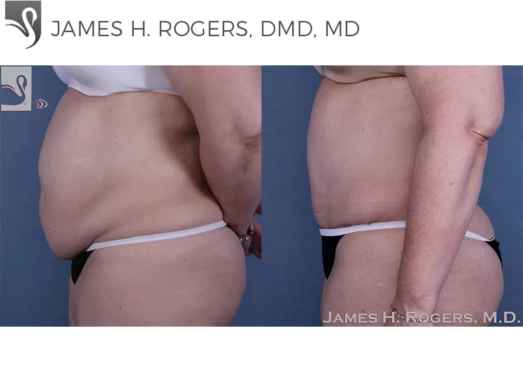 Before and After Image: Abdominoplasty (Tummy Tuck) Case #58407 - left-side