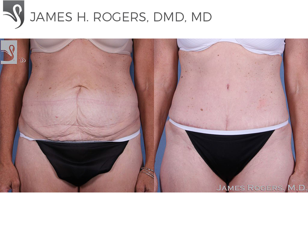 Before and After Image: Abdominoplasty (Tummy Tuck) Case #58418 - front