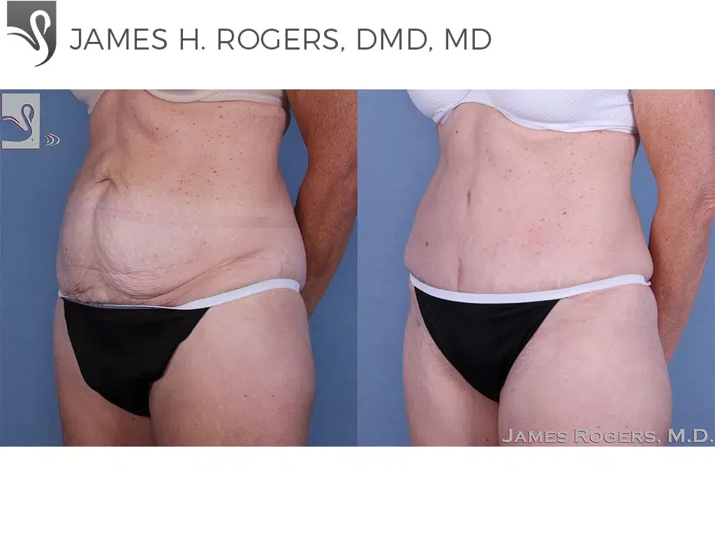 Before and After Image: Abdominoplasty (Tummy Tuck) Case #58418 - left-front-oblique