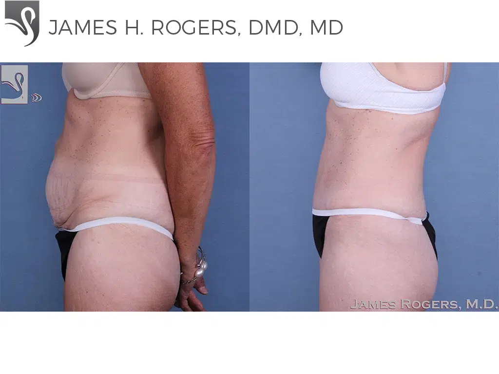 Before and After Image: Abdominoplasty (Tummy Tuck) Case #58418 - left-side