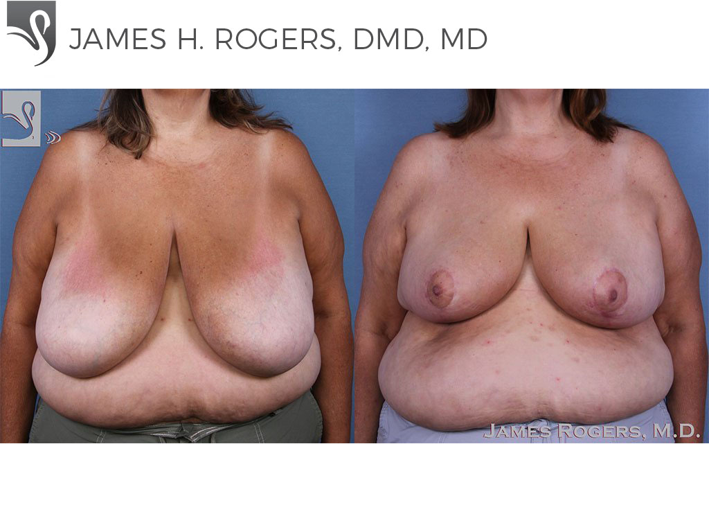 Before and After Image: Female Breast Reduction Case #58784 - front