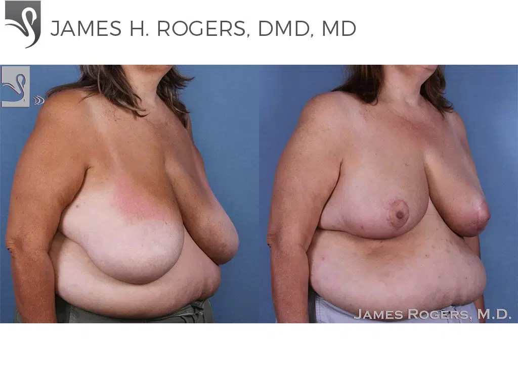 Before and After Image: Female Breast Reduction Case #58784 - right-front-oblique