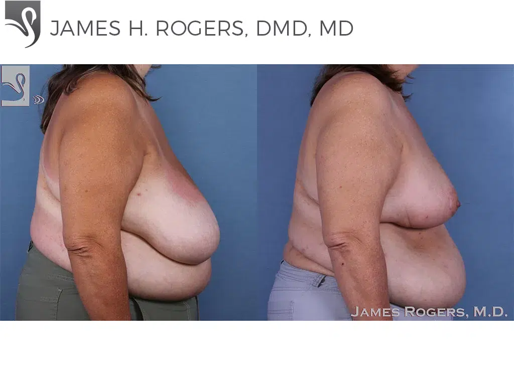Before and After Image: Female Breast Reduction Case #58784 - right-side