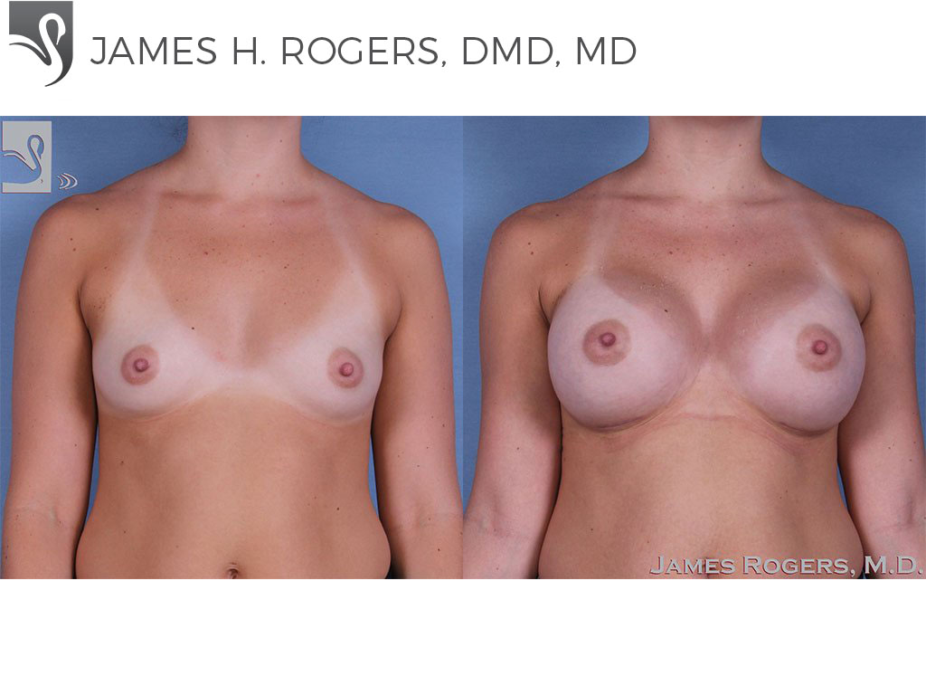 Before and After Image: Breast Augmentation Case #58799 - front