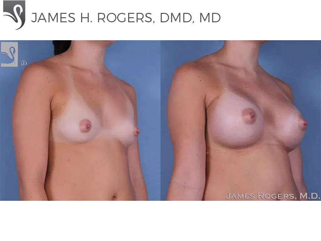 Before and After Image: Breast Augmentation Case #58799 - right-front-oblique