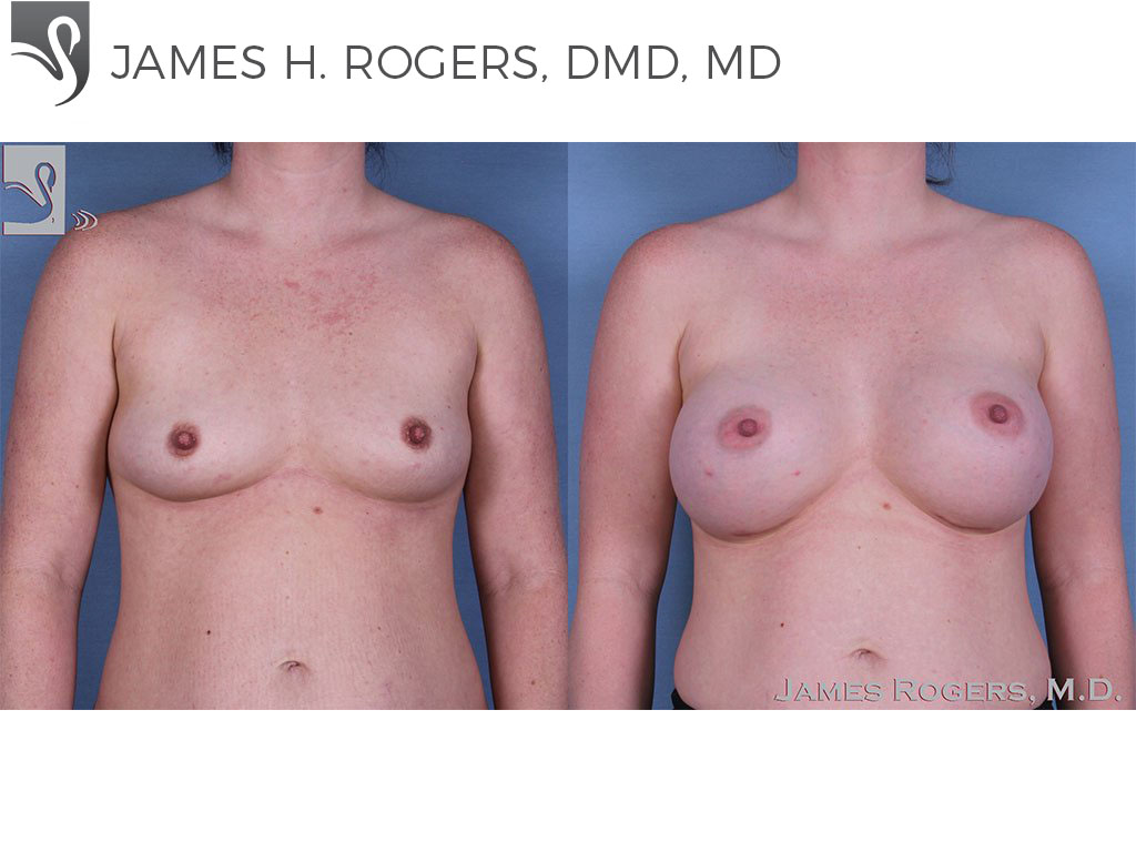 Before and After Image: Breast Augmentation Case #58823 -