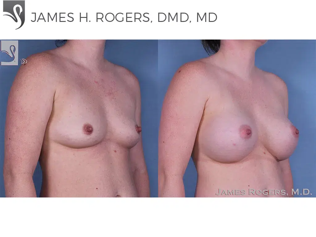 Before and After Image: Breast Augmentation Case #58823 - right-front-oblique
