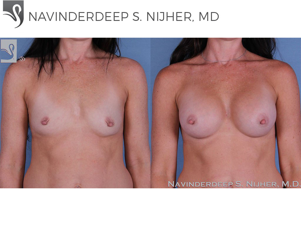 Before and After Image: Breast Augmentation Case #58889 - front