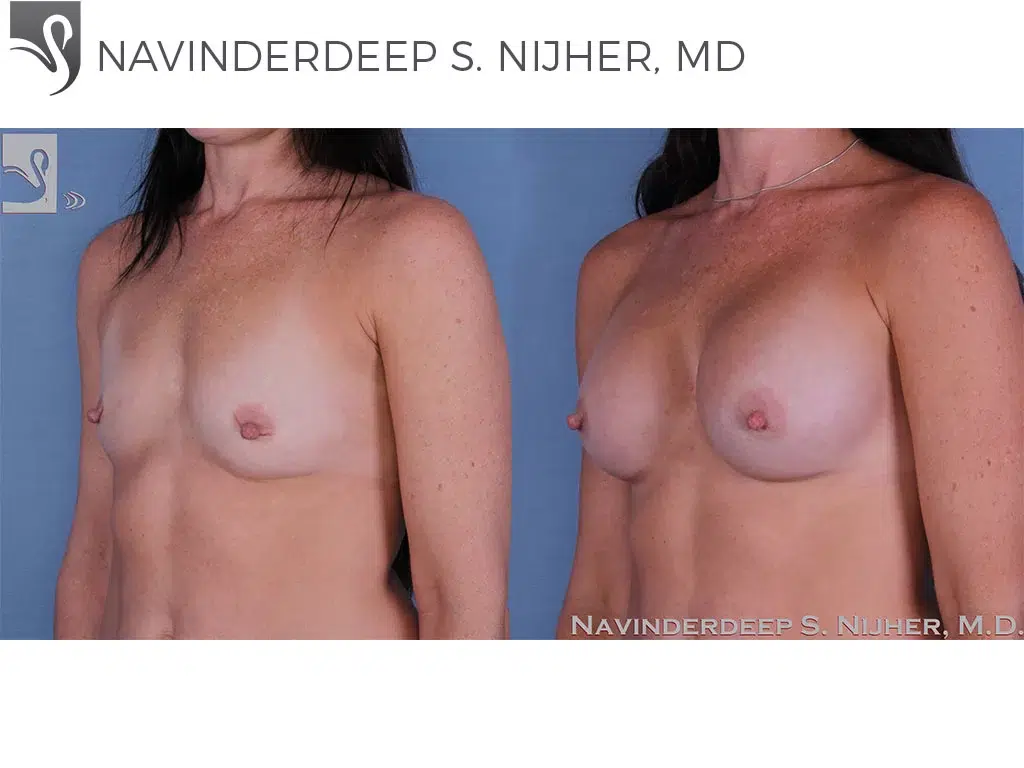 Before and After Image: Breast Augmentation Case #58889 - left-front-oblique