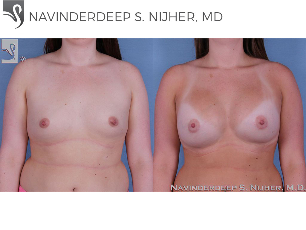 Before and After Image: Breast Augmentation Case #58955 - front