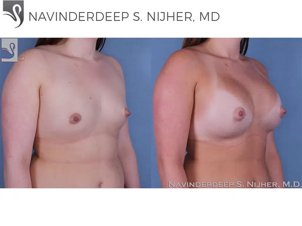 Before and After Image: Breast Augmentation Case #58955 - right-front-oblique