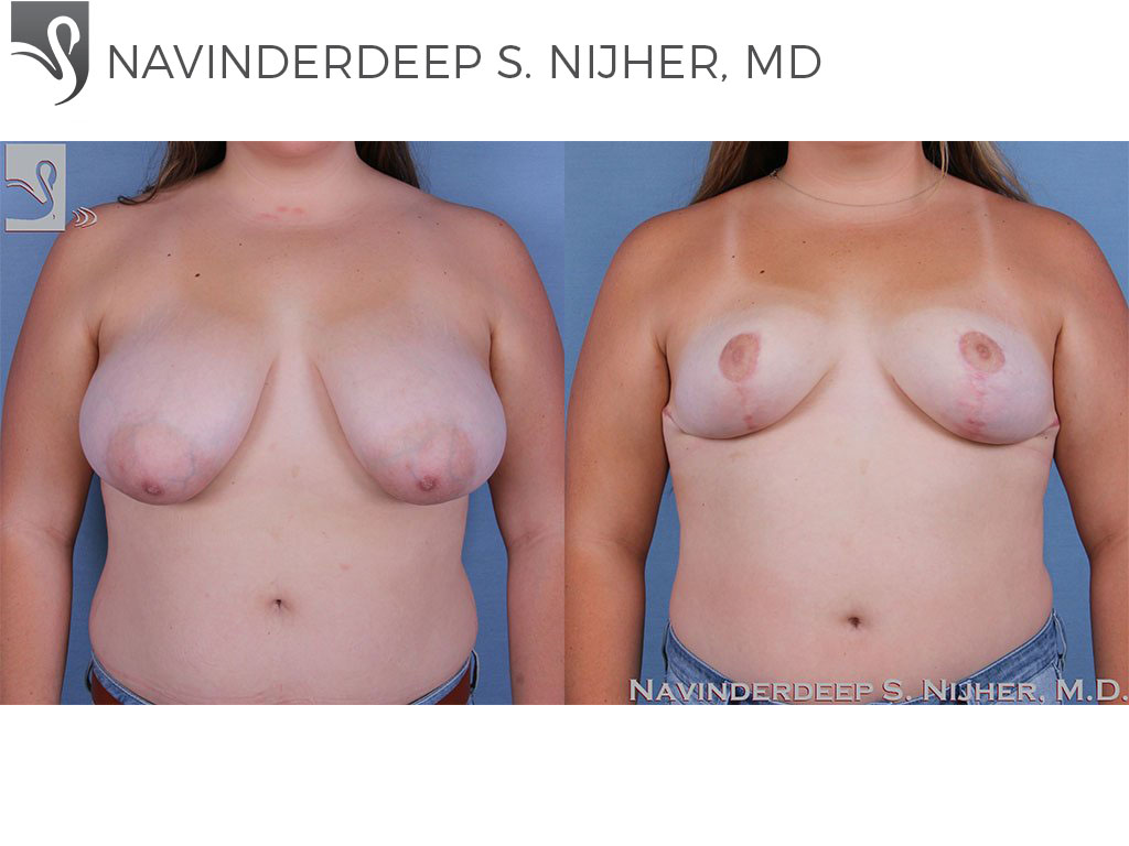 Before and After Image: Female Breast Reduction Case #59113 - front