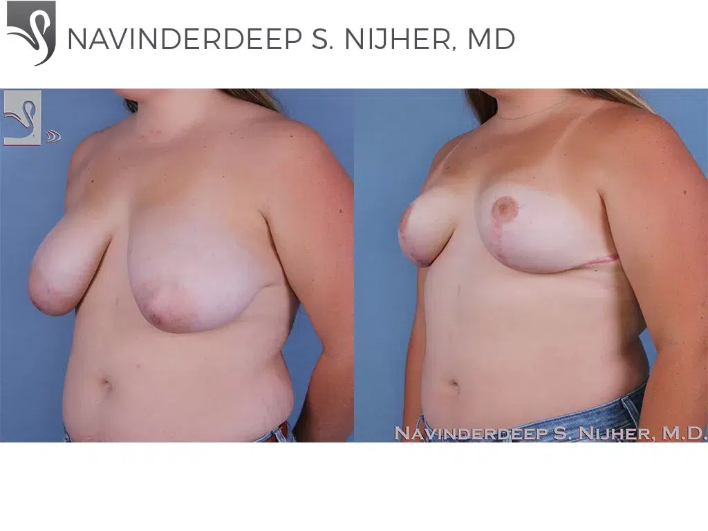 Before and After Image: Female Breast Reduction Case #59113 - left-front-oblique