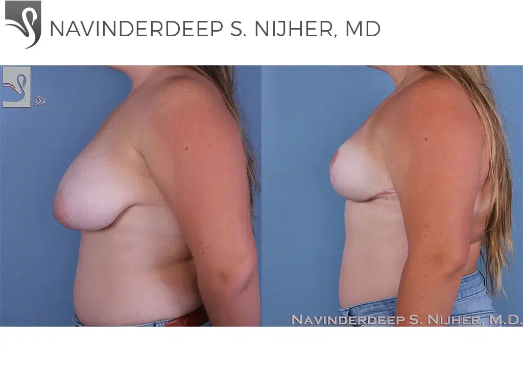 Before and After Image: Female Breast Reduction Case #59113 - left-side