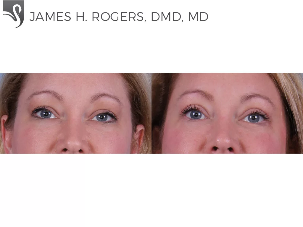 Before and After Image: Eyelid Surgery Case #59274 - front