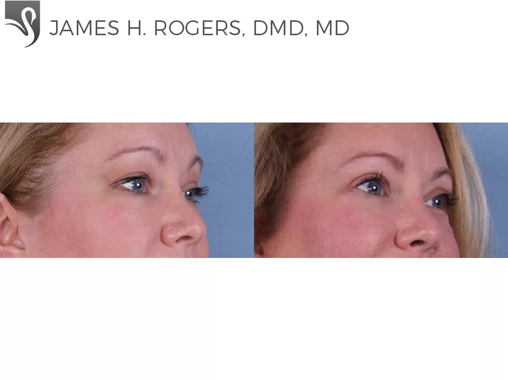 Before and After Image: Eyelid Surgery Case #59274 - right-front-oblique