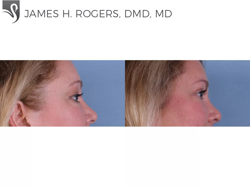 Before and After Image: Eyelid Surgery Case #59274 - right-side