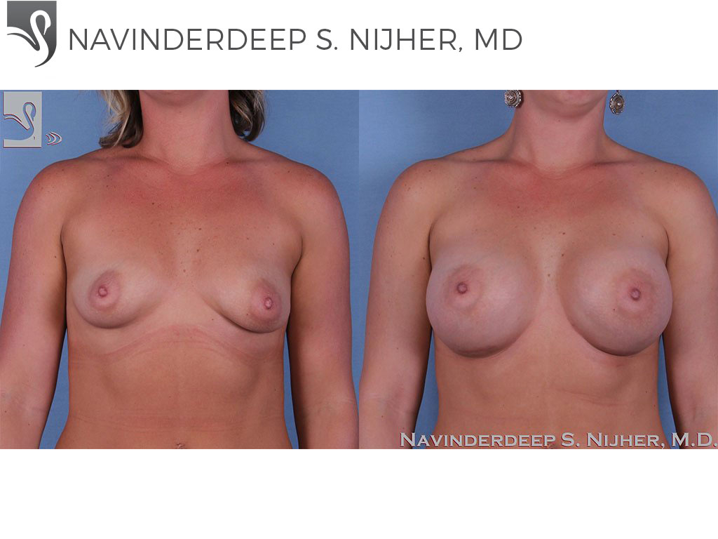 Before and After Image: Breast Augmentation Case #59398 - front