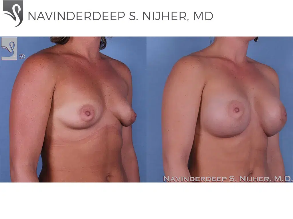 Before and After Image: Breast Augmentation Case #59398 - right-front-oblique