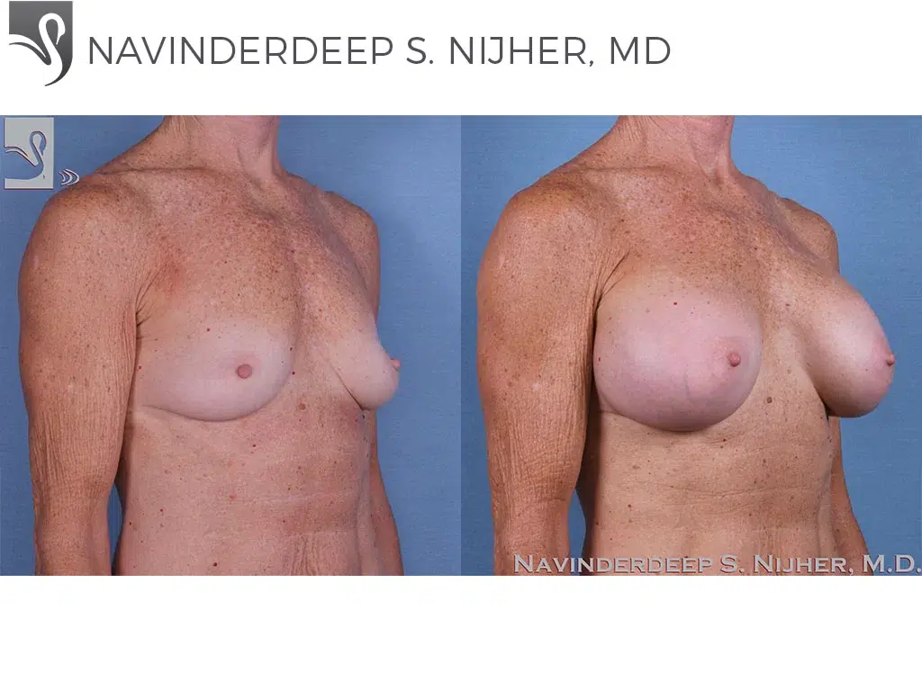 Before and After Image: Breast Augmentation Case #59437 - right-front-oblique