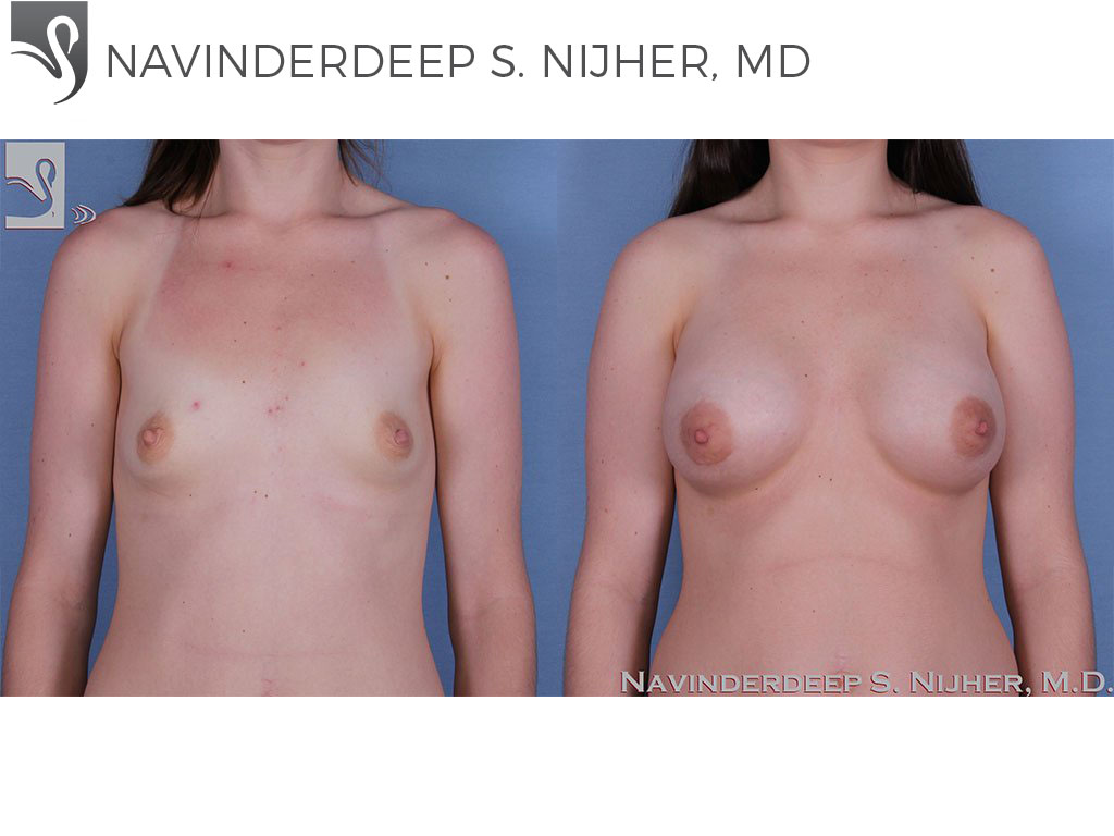 Before and After Image: Breast Augmentation Case #59700 - front