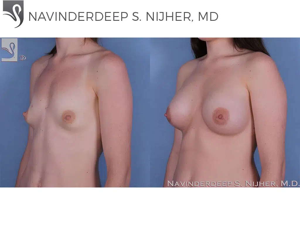 Before and After Image: Breast Augmentation Case #59700 - left-front-oblique