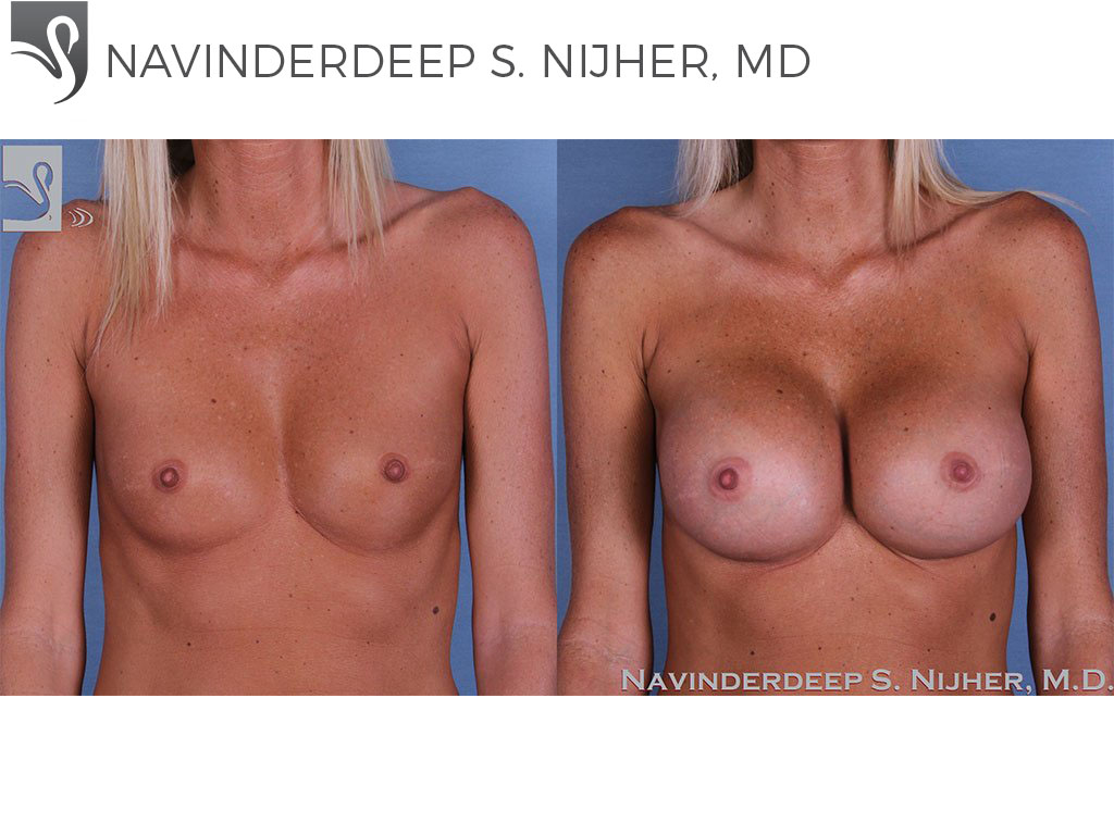 Before and After Image: Breast Augmentation Case #59727 - front