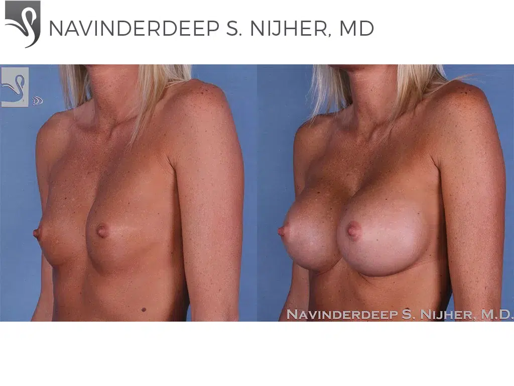 Before and After Image: Breast Augmentation Case #59727 - left-front-oblique