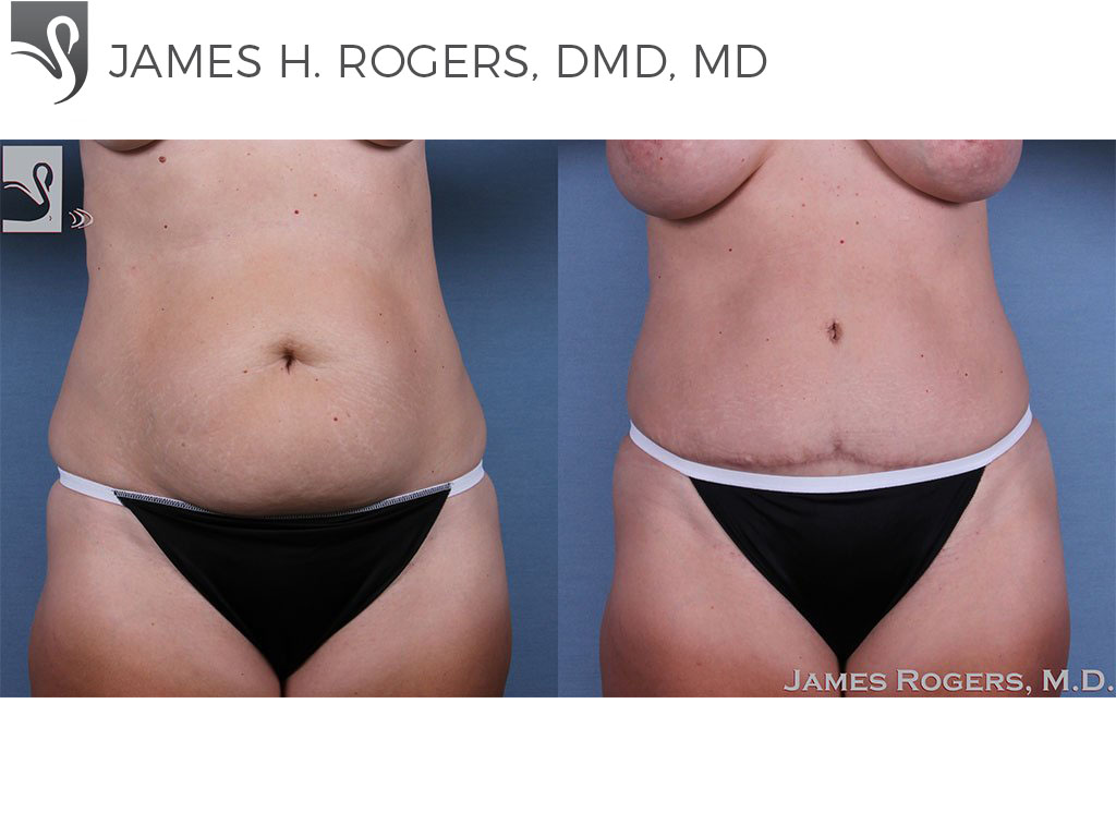 Before and After Image: Abdominoplasty (Tummy Tuck) Case #59754 - front