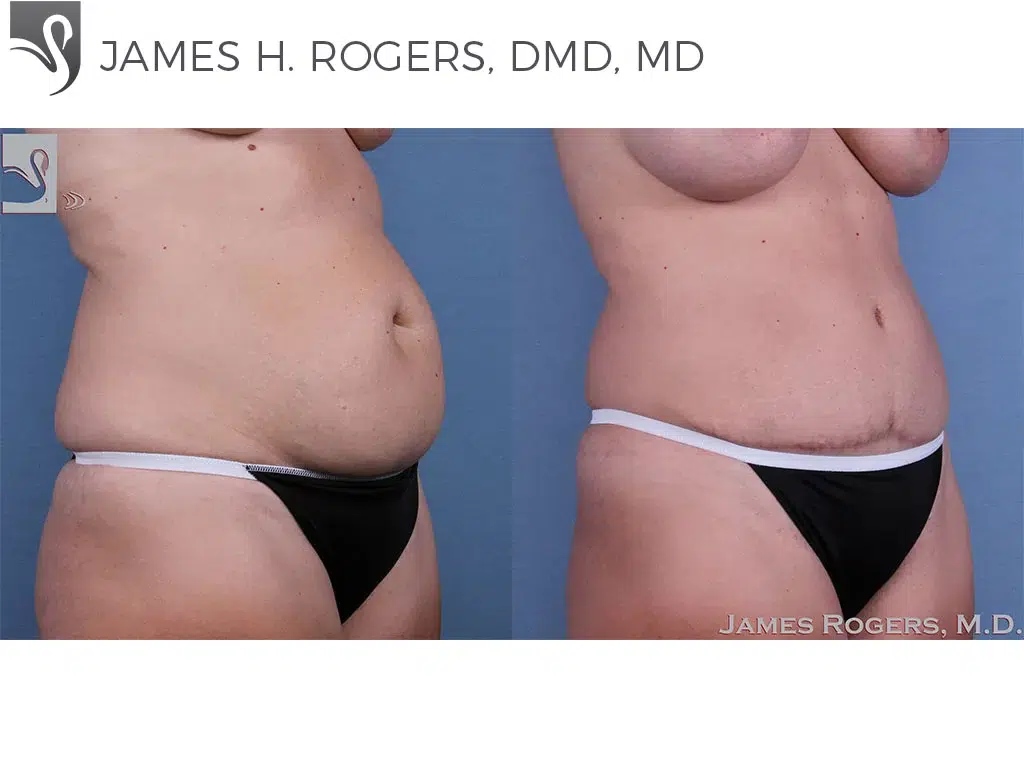 Before and After Image: Abdominoplasty (Tummy Tuck) Case #59754 - right-front-oblique