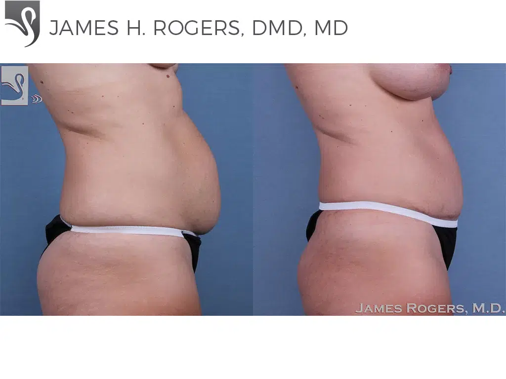 Before and After Image: Abdominoplasty (Tummy Tuck) Case #59754 - right-side