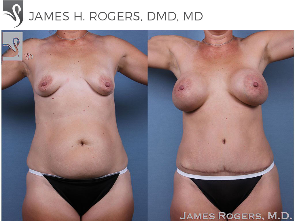 Before and After Image: Mommy Makeover Case #59754 - front