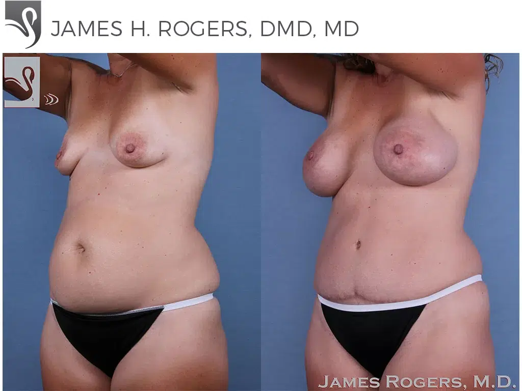 Before and After Image: Mommy Makeover Case #59754 - left-front-oblique