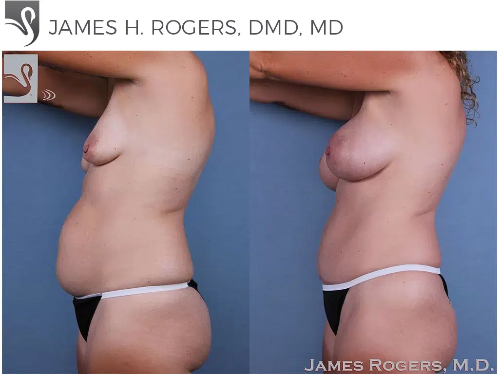 Before and After Image: Mommy Makeover Case #59754 - left-side