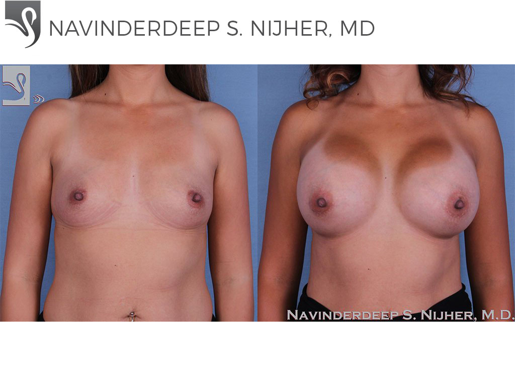 Before and After Image: Breast Augmentation Case #59812 - front