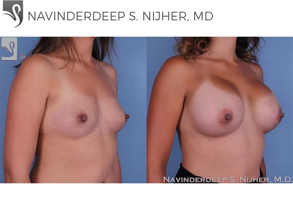 Before and After Image: Breast Augmentation Case #59812 - right-front-oblique