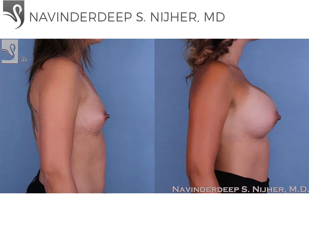 Before and After Image: Breast Augmentation Case #59812 - right-side