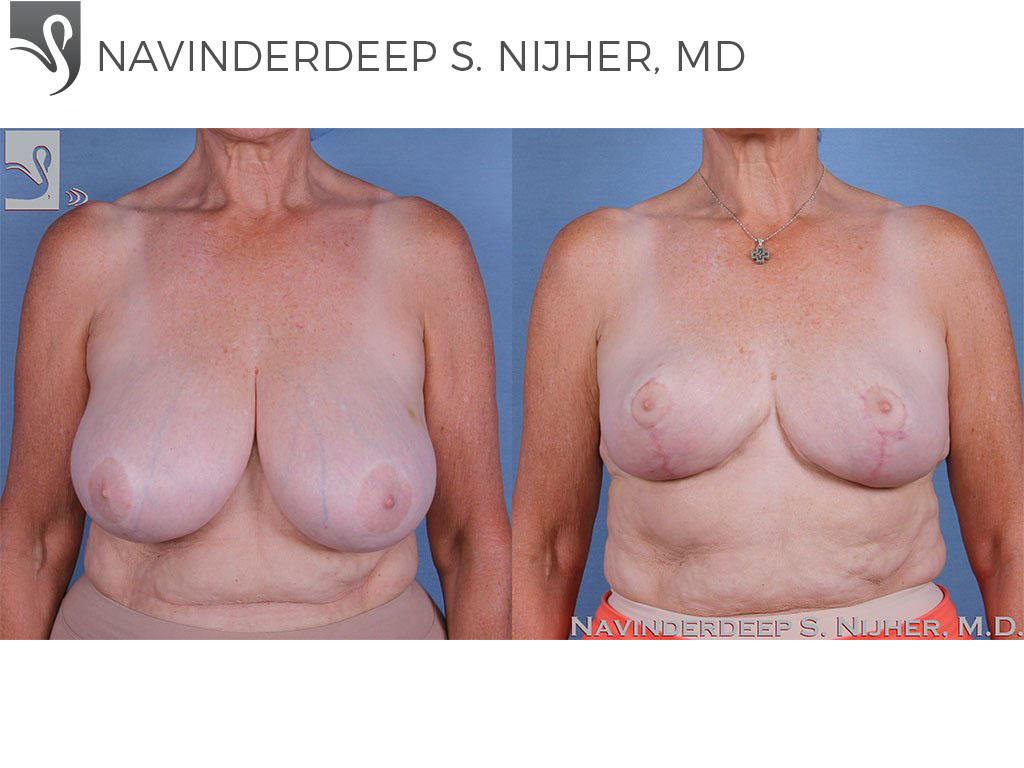 Before and After Image: Female Breast Reduction Case #59813 - front